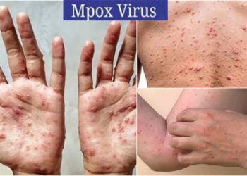 পাকিস্তানে প্রথম মারাত্মক এমপক্স ভাইরাসের সংক্রমণ শনাক্ত