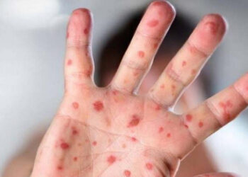 মাঙ্কিপক্স কী, যেভাবে ছড়ায়