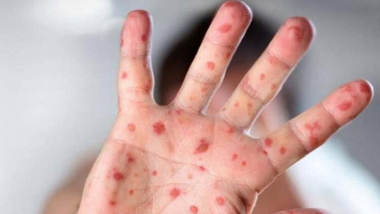 মাঙ্কিপক্স কী, যেভাবে ছড়ায়