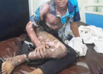 কর্ণফুলীতে স্বাস্থ্য কমপ্লেক্সের মাঠে গোপন হাটে বিদ্যুৎস্পৃষ্টে দগ্ধ কিশোর